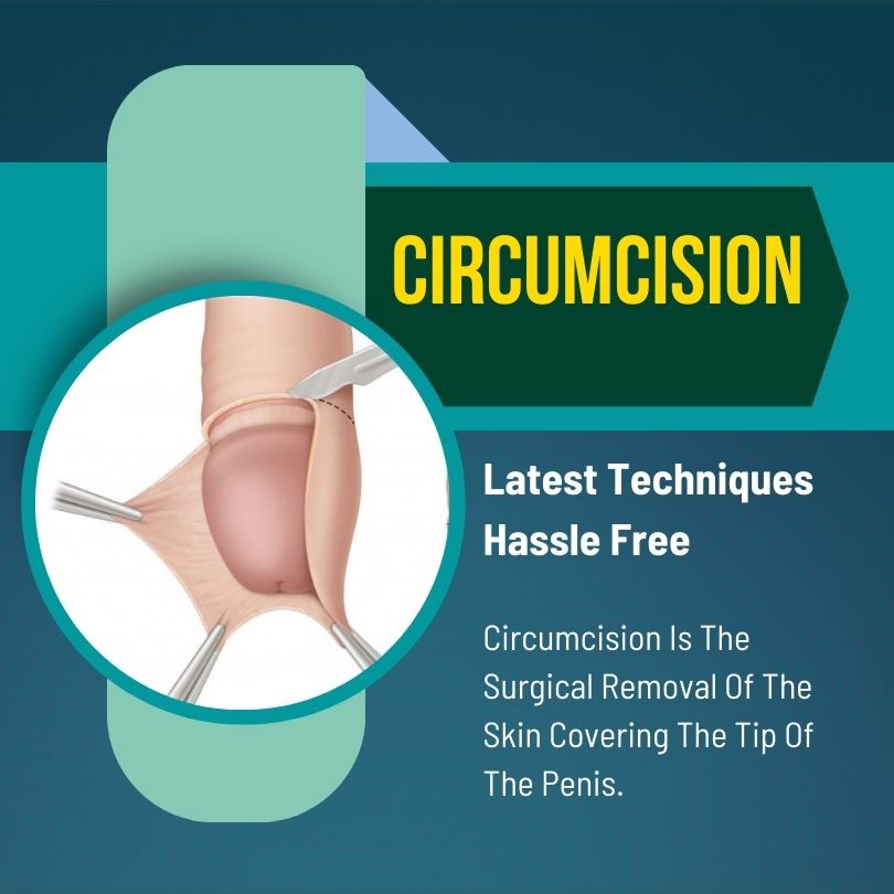 Circumcision