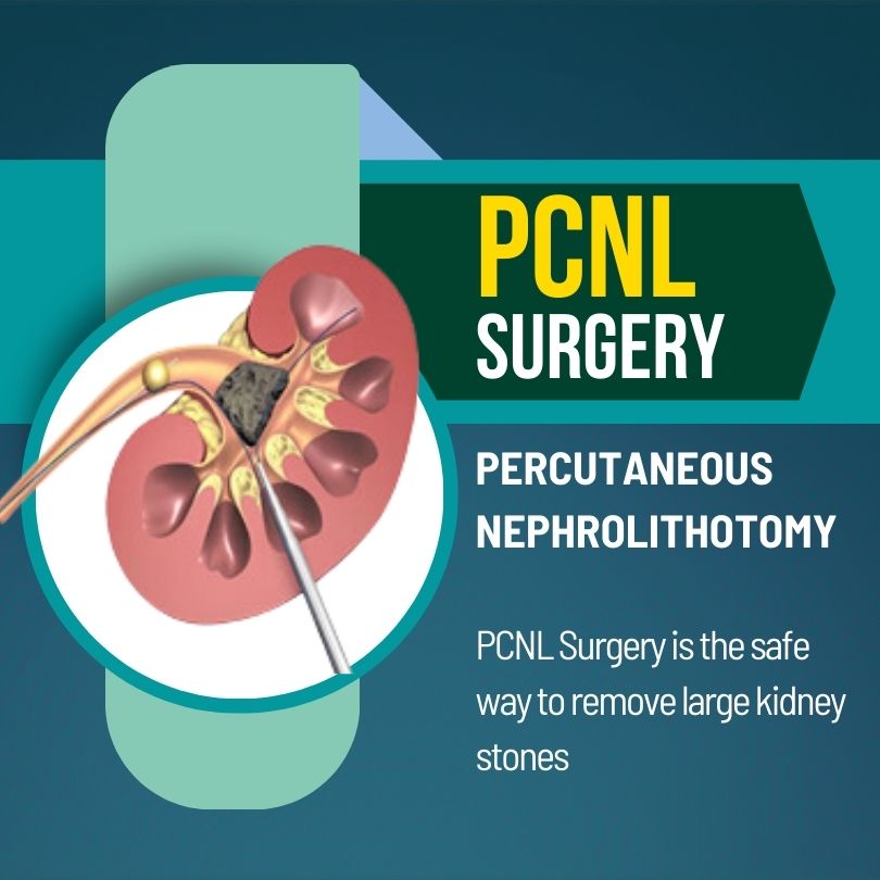 PCNL Surgery