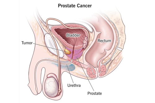 Prostate Cancer explanation