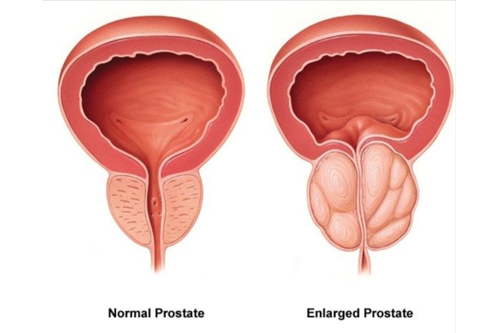 normal Prostate and swelling prostate Problems explain