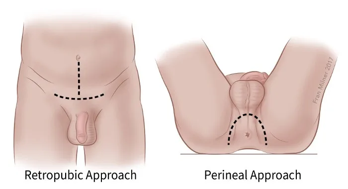 Prostate Surgeon In Balaghat