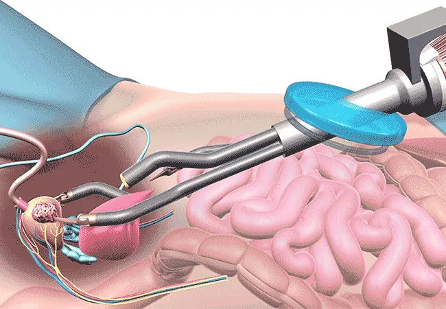 Prostate Surgeon In Betul