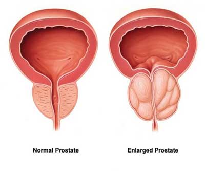 Prostate Surgeon In Jabalpur