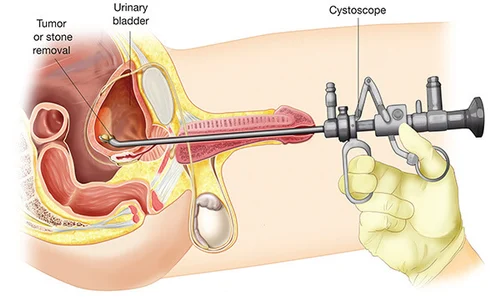 Prostate Surgeon In Rewa